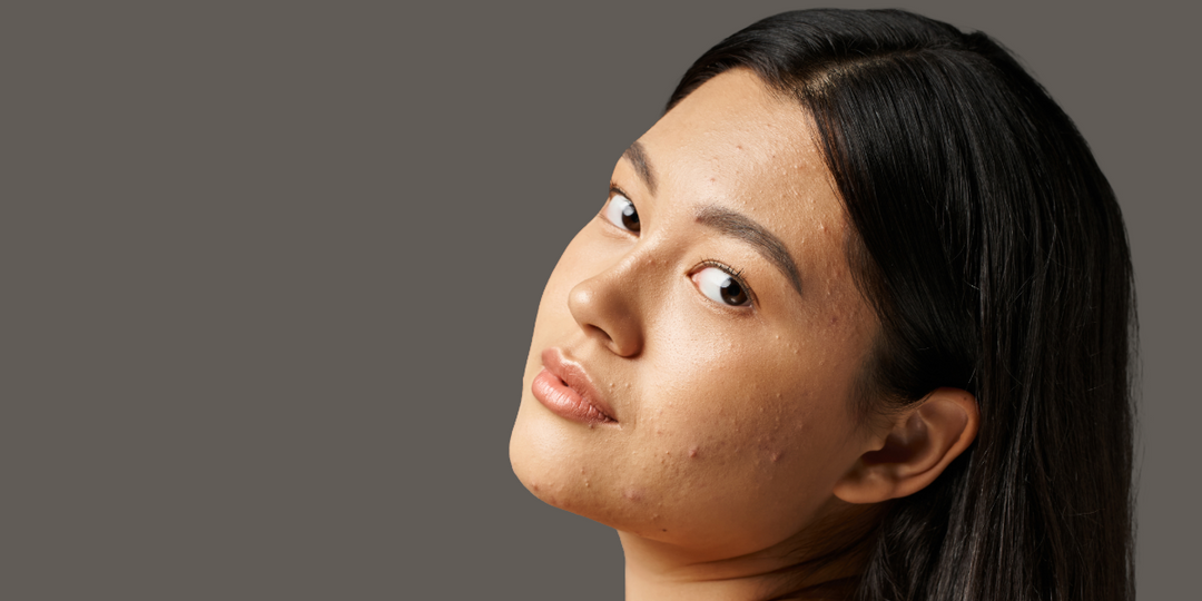 Acne-Prone Skin
