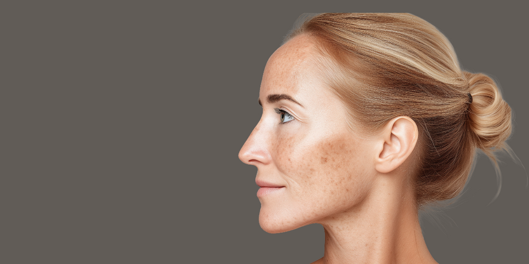 Uneven Skin Tone