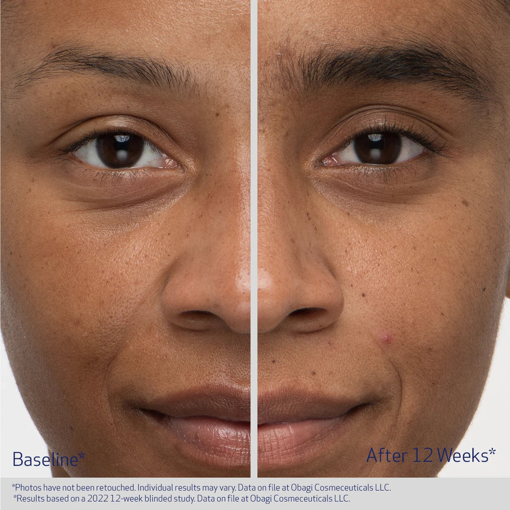 Before and after comparison of a person's face with visible skin improvement over 12 weeks.