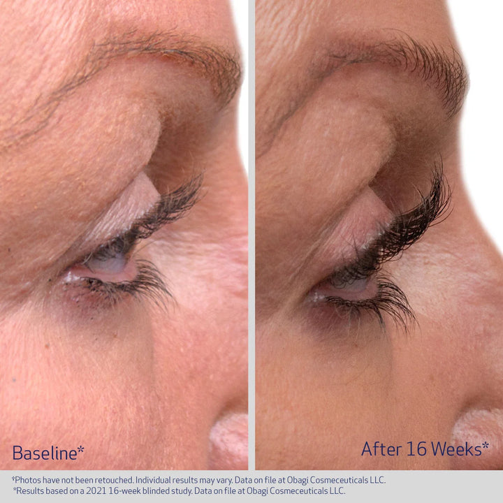 Before and after comparison of eye area treatment showing reduced wrinkles.