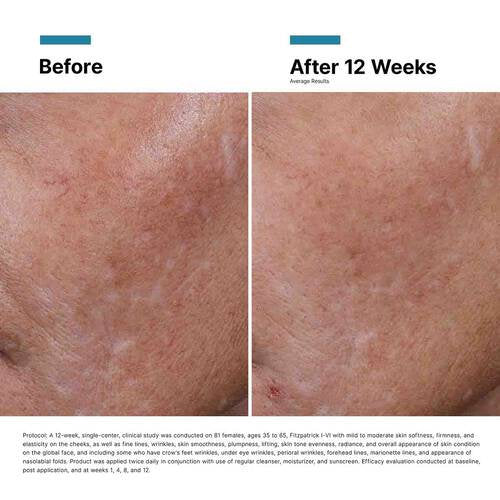 Botox® Bundle