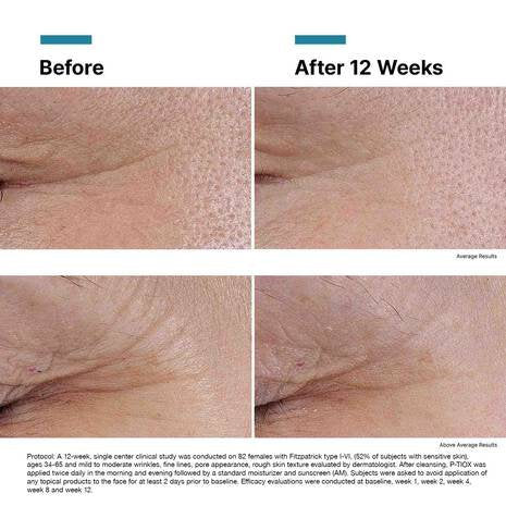 Botox® Bundle