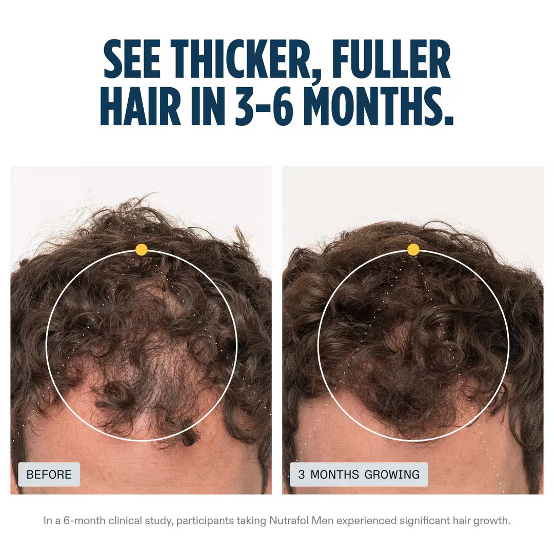 Before and after comparison of hair growth with Nutrafol Men product.