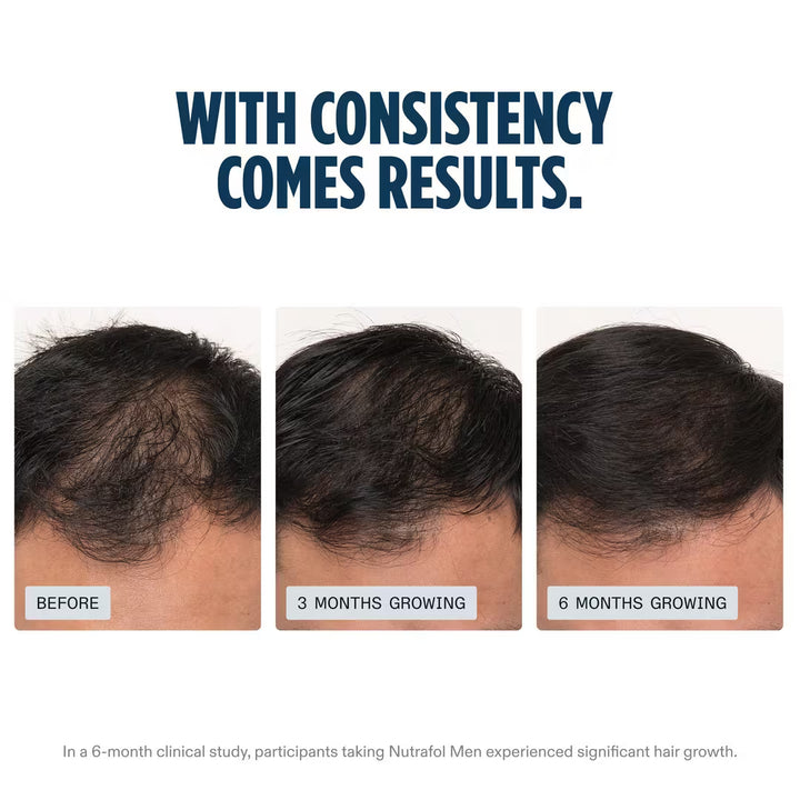 Before and after hair growth results using Nutrafol Men product.