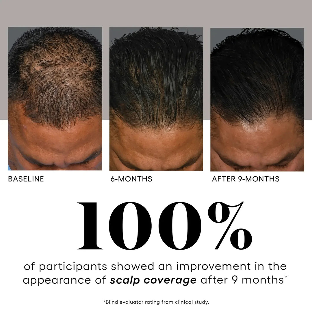 Before and after comparison of scalp coverage with text indicating improvement over 9 months.