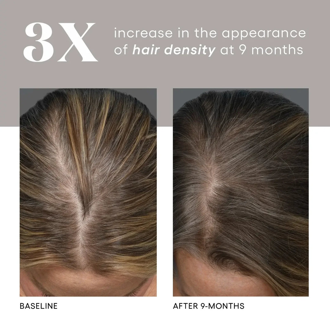 Before and after comparison of hair density increase with text indicating 3x improvement at 9 months.