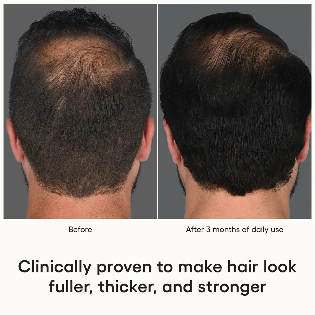 Before and after comparison of hair growth treatment showing a man&